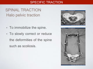 SPECIFIC TRACTION
SPINAL TRACTION
• To immobilize the spine.
• To slowly correct or reduce
the deformities of the spine
such as scoliosis.
Halo pelvic traction
 