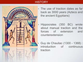 HISTORY
• The use of traction dates as far
back as 3000 years (Aztecs and
the ancient Egyptians)
• Hippocrates (350 BC) wrote
about manual traction and the
forces of extension and
counterextension
• Guy de Chauliac (1300 - 1368) :
introduction of continuous
traction
 