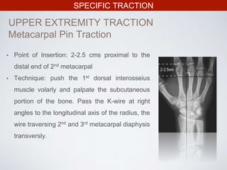 SPECIFIC TRACTION
UPPER EXTREMITY TRACTION
Metacarpal Pin Traction
• Point of Insertion: 2-2.5 cms proximal to the
distal end of 2nd metacarpal
• Technique: push the 1st dorsal interosseius
muscle volarly and palpate the subcutaneous
portion of the bone. Pass the K-wire at right
angles to the longitudinal axis of the radius, the
wire traversing 2nd and 3rd metacarpal diaphysis
transversly.
 