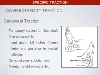 SPECIFIC TRACTION
LOWER EXTREMITY TRACTION
• Temporary traction for tibial shaft
fx or calcaneal fx
• Insert about 1.5 inches (4cms)
inferior and posterior to medial
malleolus
• Do not skewer subtalar joint
• Maintain slight elevation leg
Calcaneal Traction
 