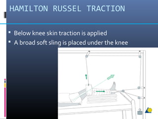 HAMILTON RUSSEL TRACTION
 Below knee skin traction is applied
 A broad soft sling is placed under the knee
 