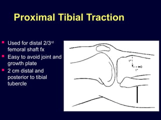Distal Traction Rotation traction_in_orthopaedics new orthoapedics .pptx