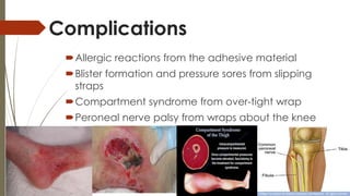 Complications 
Allergic reactions from the adhesive material 
Blister formation and pressure sores from slipping 
straps 
Compartment syndrome from over-tight wrap 
Peroneal nerve palsy from wraps about the knee 
 