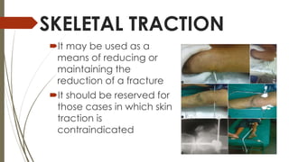 SKELETAL TRACTION 
It may be used as a 
means of reducing or 
maintaining the 
reduction of a fracture 
It should be reserved for 
those cases in which skin 
traction is 
contraindicated 
 