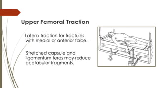 Upper Femoral Traction 
Lateral traction for fractures 
with medial or anterior force. 
Stretched capsule and 
ligamentum teres may reduce 
acetabular fragments. 
 