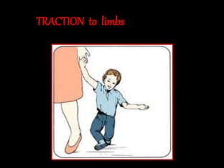 TRACTION to limbs
 
