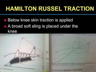 HAMILTON RUSSEL TRACTION
 Below knee skin traction is applied
 A broad soft sling is placed under the
knee
 