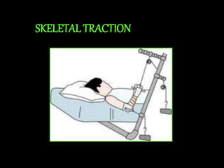 SKELETAL TRACTION
 