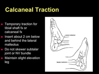 Calcaneal Traction
 Temporary traction for
tibial shaft fx or
calcaneal fx
 Insert about 2 cm below
and behind the lateral
malleolus
 Do not skewer subtalar
joint or NV bundle
 Maintain slight elevation
leg
 
