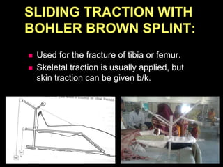 SLIDING TRACTION WITH
BOHLER BROWN SPLINT:
 Used for the fracture of tibia or femur.
 Skeletal traction is usually applied, but
skin traction can be given b/k.
 
