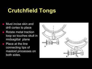 Crutchfield Tongs
 Must incise skin and
drill cortex to place
 Rotate metal traction
loop so touches skull in
midsagittal plane
 Place at the line
connecting tips of
mastoid processes on
both sides.
 
