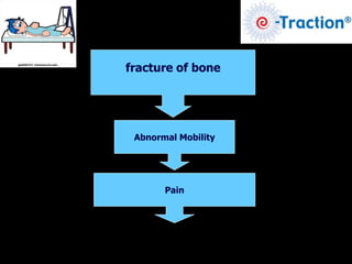 fracture of bone
Abnormal Mobility
Pain
 