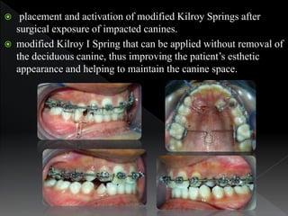 orthodonticTraction of impacted maxillary canine and Piggyback ...