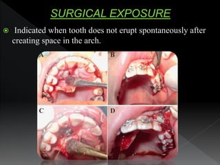  Indicated when tooth does not erupt spontaneously after
creating space in the arch.
 