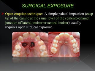  Open eruption technique: A simple palatal impaction (cusp
tip of the canine at the same level of the cemento-enamel
junc...