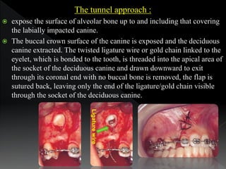 The tunnel approach :
 expose the surface of alveolar bone up to and including that covering
the labially impacted canine...