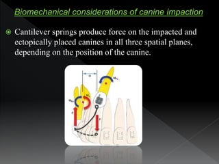  Cantilever springs produce force on the impacted and
ectopically placed canines in all three spatial planes,
depending o...