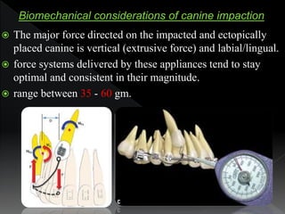  The major force directed on the impacted and ectopically
placed canine is vertical (extrusive force) and labial/lingual....