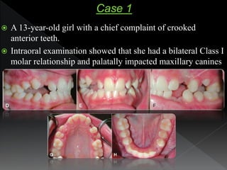  A 13-year-old girl with a chief complaint of crooked
anterior teeth.
 Intraoral examination showed that she had a bilat...