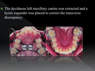  The deciduous left maxillary canine was extracted and a
hyrax expander was placed to correct the transverse
discrepancy.
 