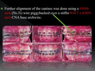  Further alignment of the canines was done using a 0.016-
inch (Ni-Ti) wire piggybacked over a stiffer 0.017 x 0.025-
inc...