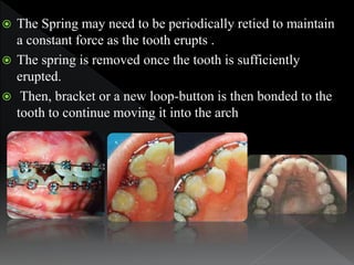  The Spring may need to be periodically retied to maintain
a constant force as the tooth erupts .
 The spring is removed...