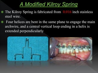  The Kilroy Spring is fabricated from 0.016 inch stainless
steel wire.
 Four helices are bent in the same plane to engag...
