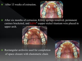 After 13 weeks of extrusion.
 After six months of extrusion, Kilroy springs removed, permanent
canines bracketed, and 0...