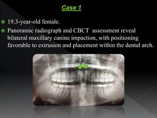  19.3-year-old female.
 Panoramic radiograph and CBCT assessment reveal
bilateral maxillary canine impaction, with posit...