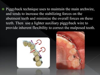 Piggyback technique uses to maintain the main archwire,
and tends to increase the stabilizing forces on the
abutment tee...