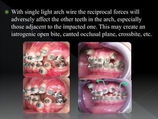  With single light arch wire the reciprocal forces will
adversely affect the other teeth in the arch, especially
those ad...