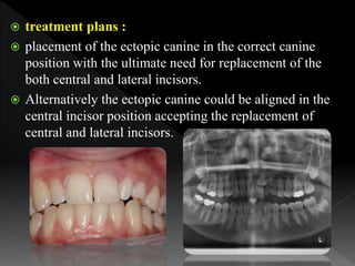 treatment plans :
 placement of the ectopic canine in the correct canine
position with the ultimate need for replacemen...