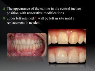  The appearance of the canine in the central incisor
position with restorative modifications.
 upper left retained C wil...