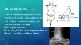 Distal Traction Rotation Tractions | PPTX