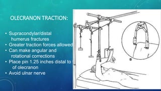Distal Traction Rotation Tractions | PPTX