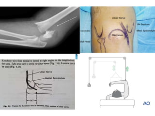 Tractions in Orthopaedics.ppt