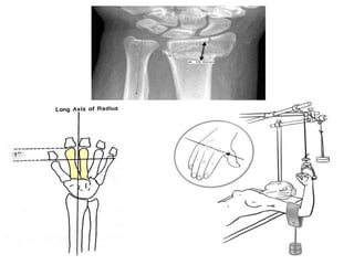 Tractions in Orthopaedics.ppt