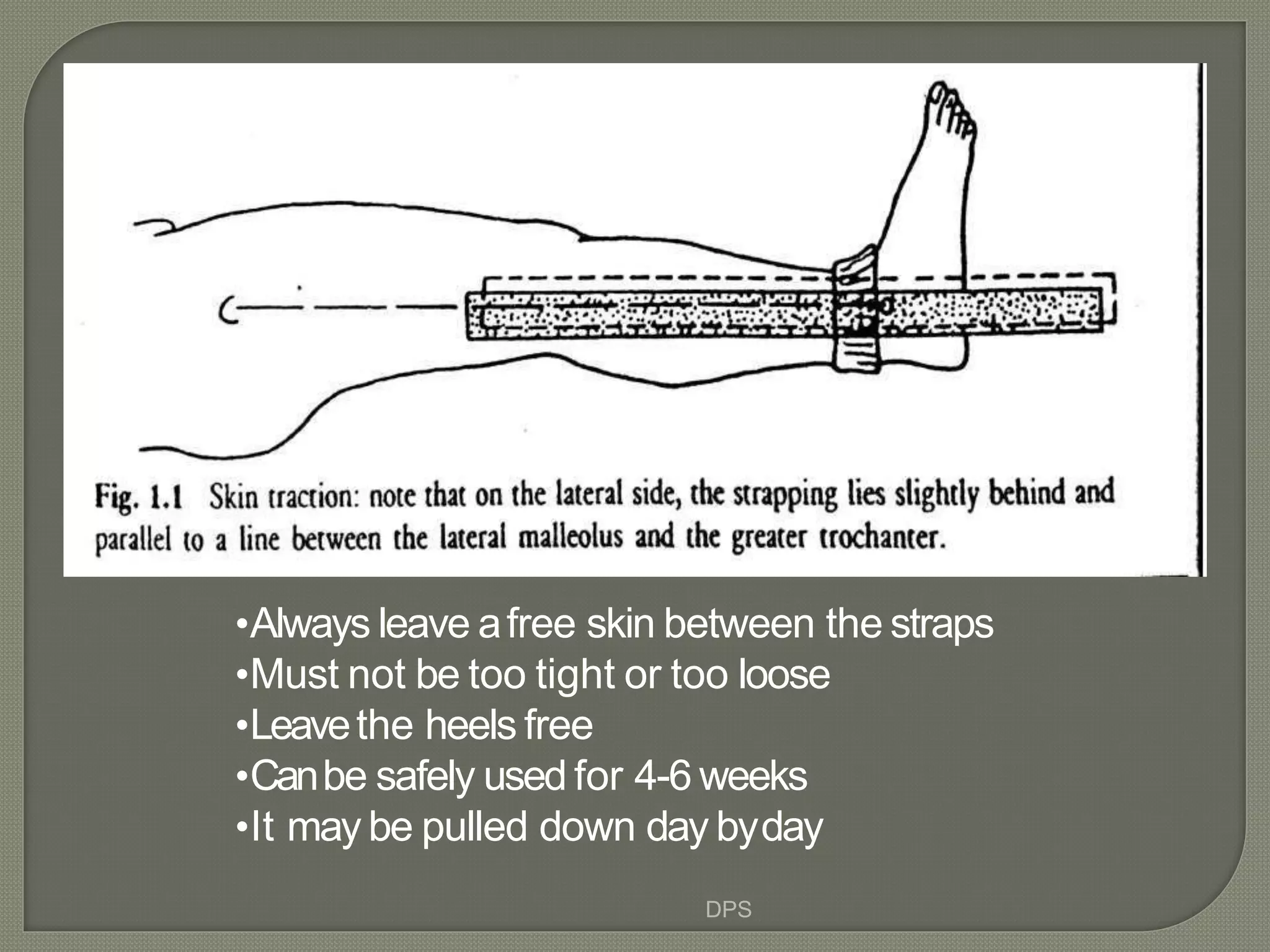 Traction Use Tractions in orthopaedics by dr. d. p. swami | PPT