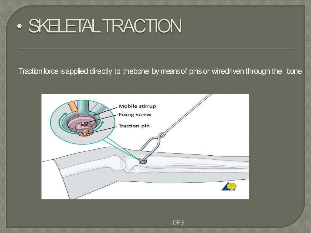 Tractions in orthopaedics by dr. d. p. swami
