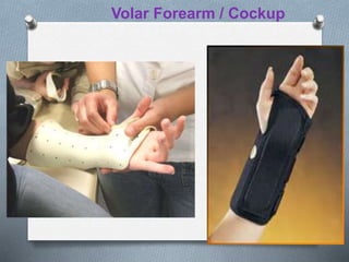 Volar Forearm / Cockup
 