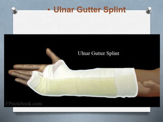• Ulnar Gutter Splint
 