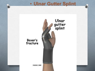 • Ulnar Gutter Splint
 