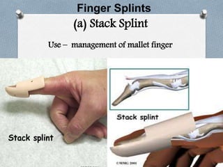 Finger Splints
(a) Stack Splint
Use – management of mallet finger
 
