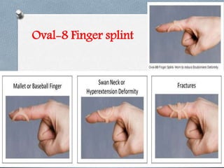 Oval-8 Finger splint
 