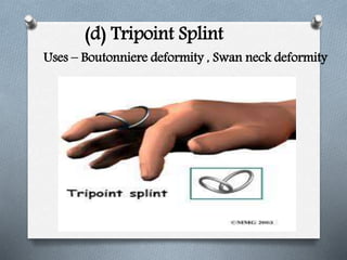 (d) Tripoint Splint
Uses – Boutonniere deformity , Swan neck deformity
 