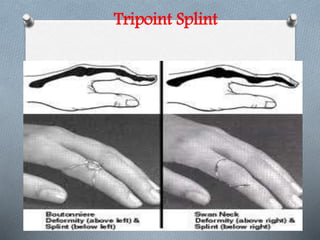 Tripoint Splint
 