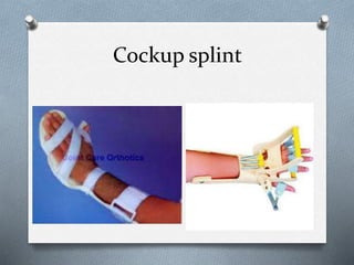 Cockup splint
 