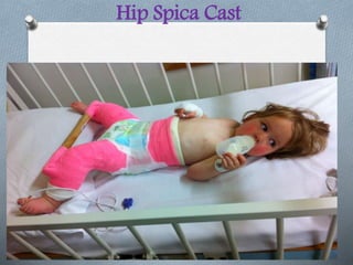 Hip Spica Cast
 