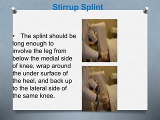 • The splint should be
long enough to
involve the leg from
below the medial side
of knee, wrap around
the under surface of
the heel, and back up
to the lateral side of
the same knee.
Stirrup Splint
 