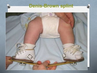 Denis-Brown splint
 